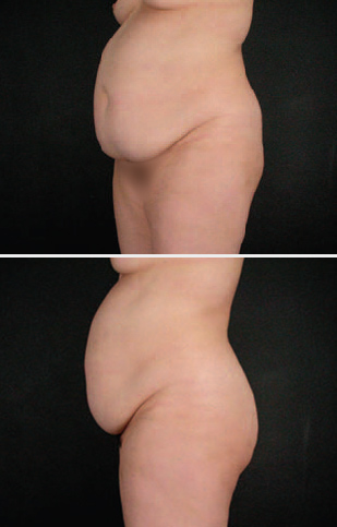 abdominoplasty1