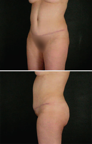 abdominoplasty2