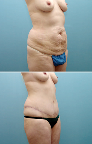 abdominoplasty3