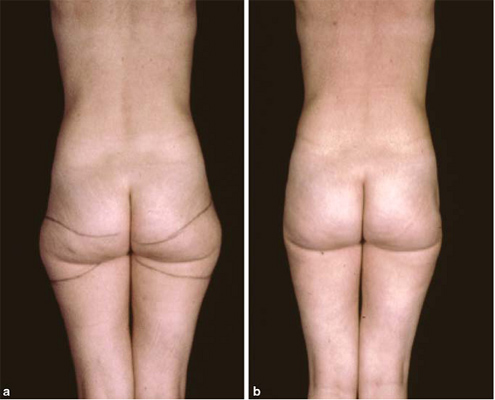 liposuction1